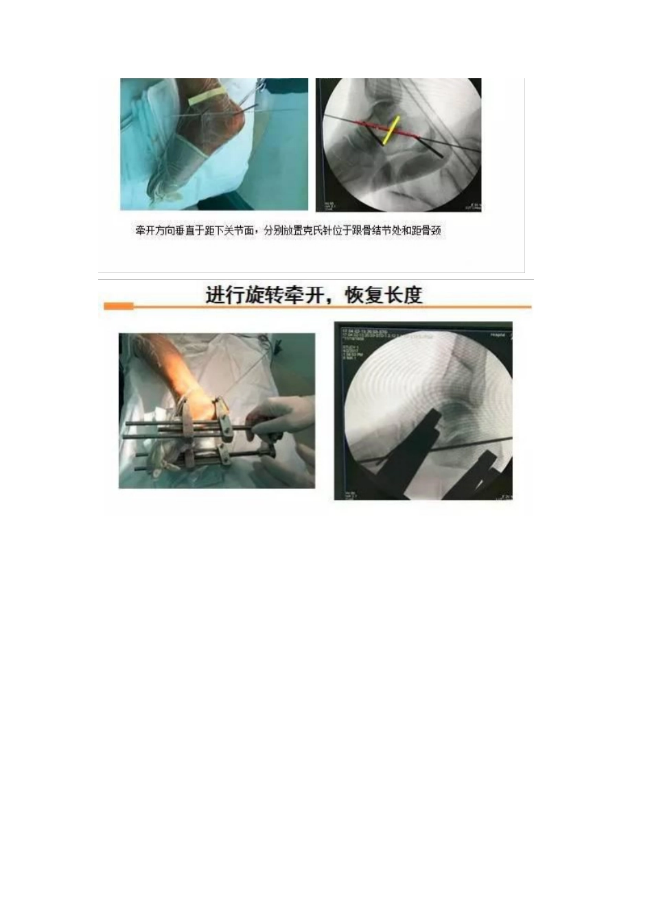 跟骨微创手术的经验与陷阱_第9页