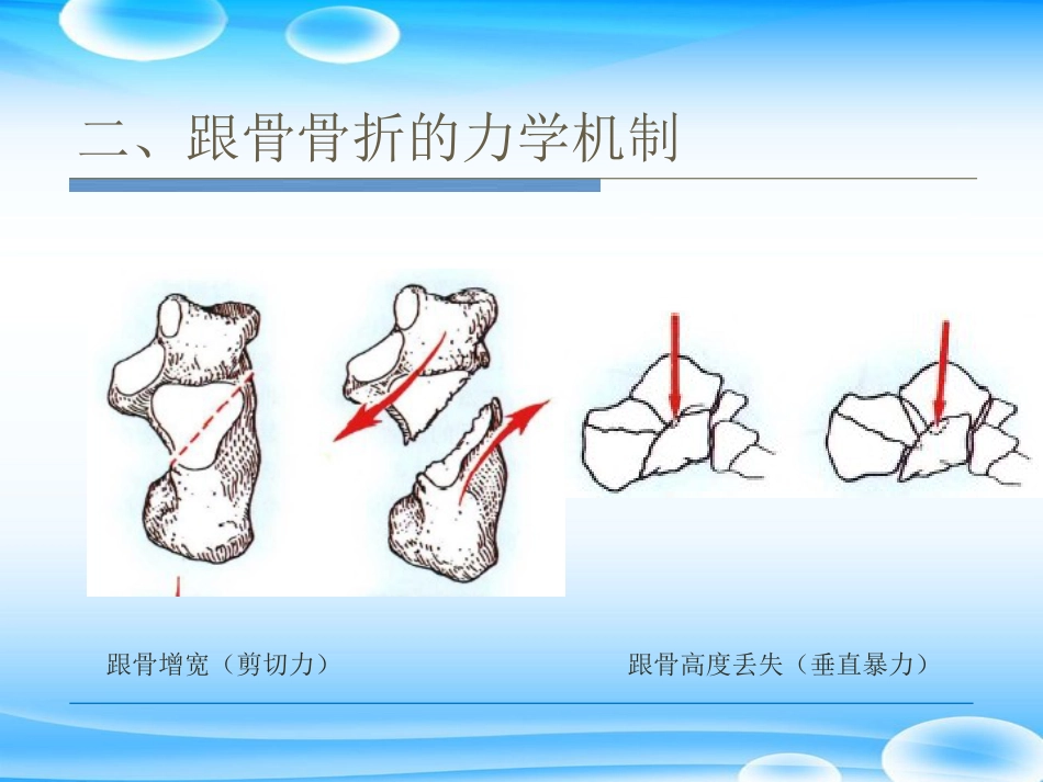 跟骨骨折ORIF的技巧PPT课件_第10页