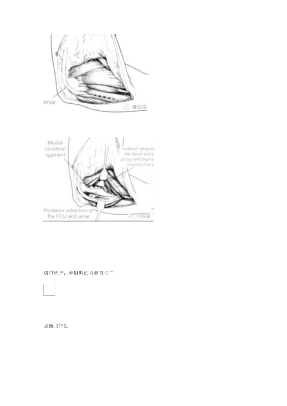 冠突骨折手术技巧_第8页