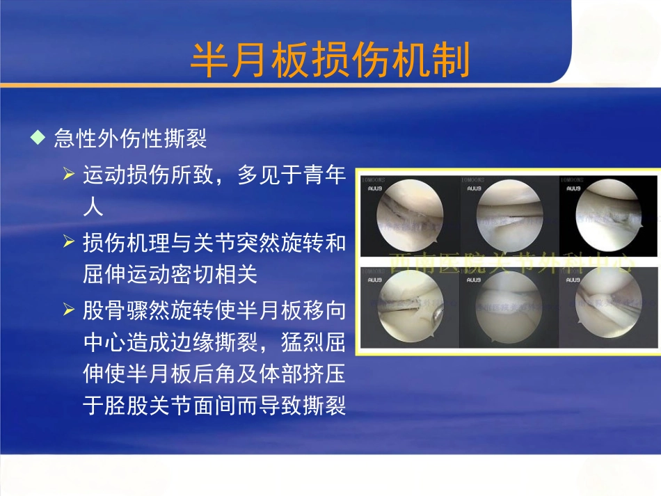 膝关节半月板损伤的诊断_第3页