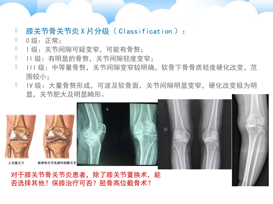 保膝治疗之一——胫骨高位截骨术_第2页