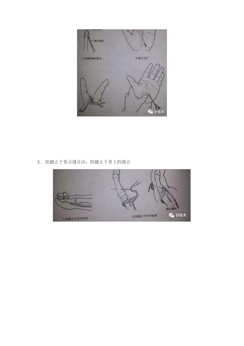 肌腱缝合术方法汇总_第12页