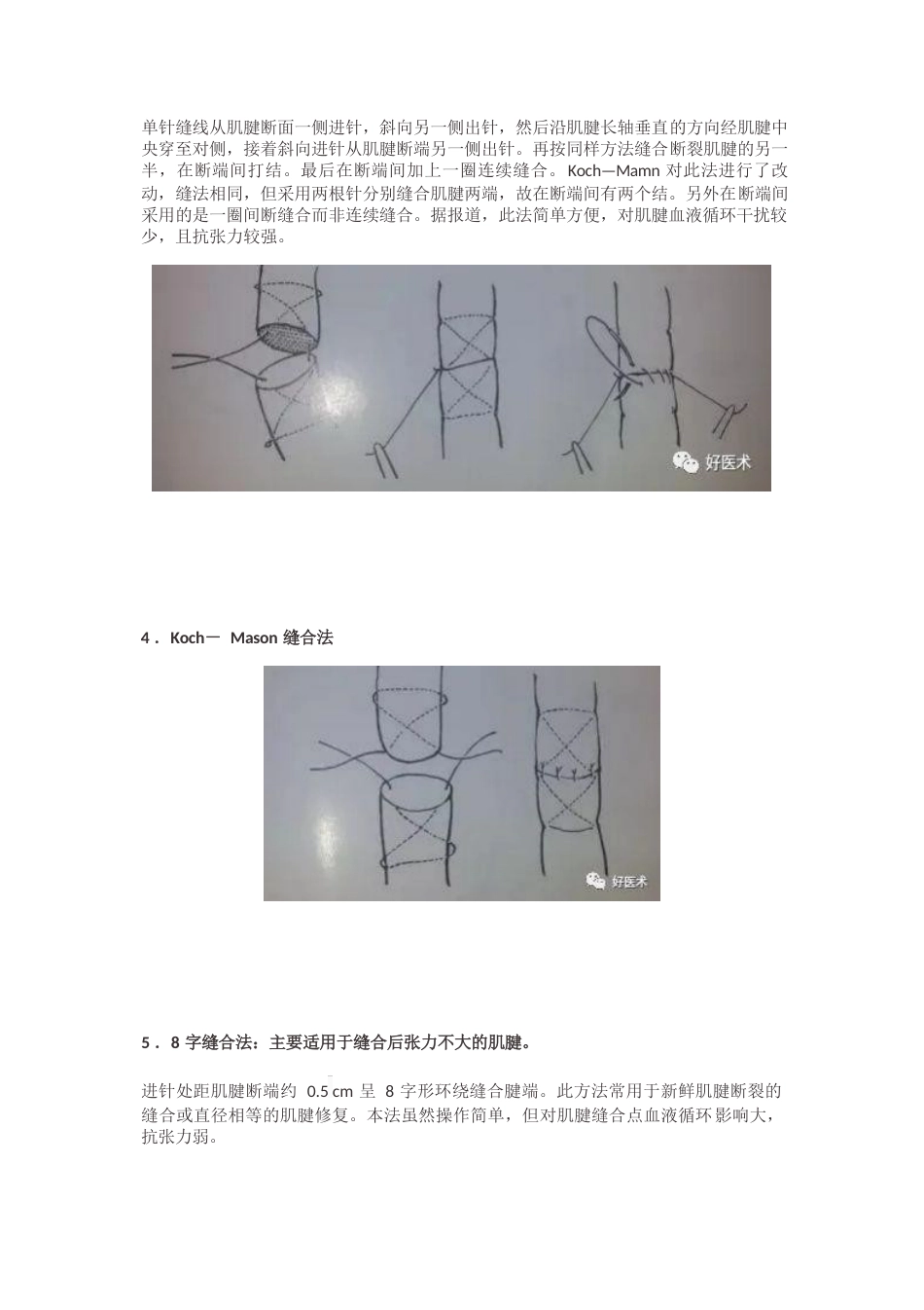 肌腱缝合术方法汇总_第7页