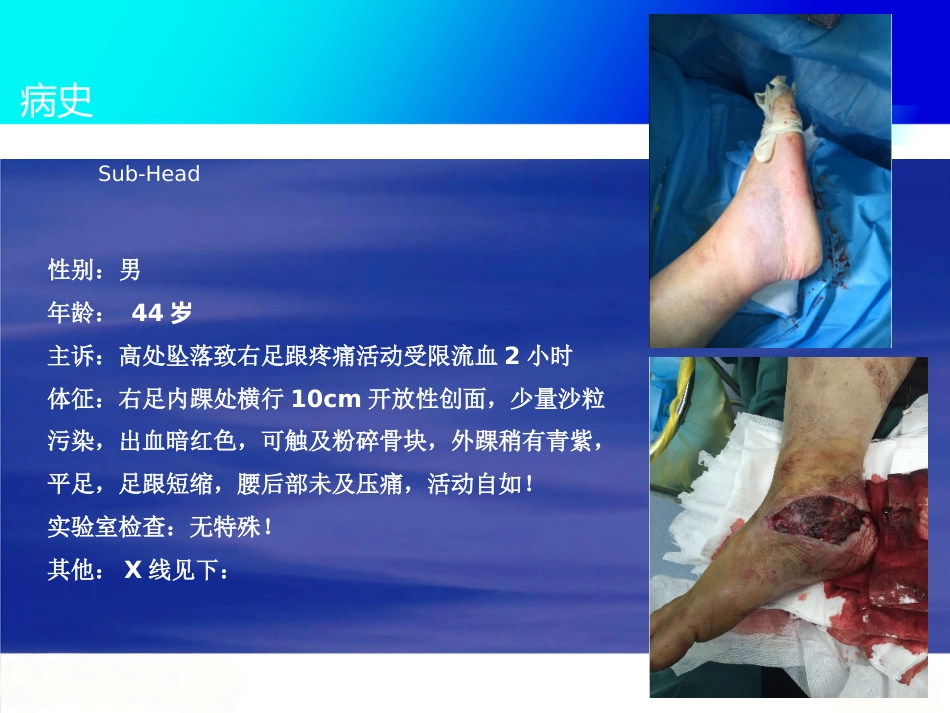 微创跟骨骨折新_第2页