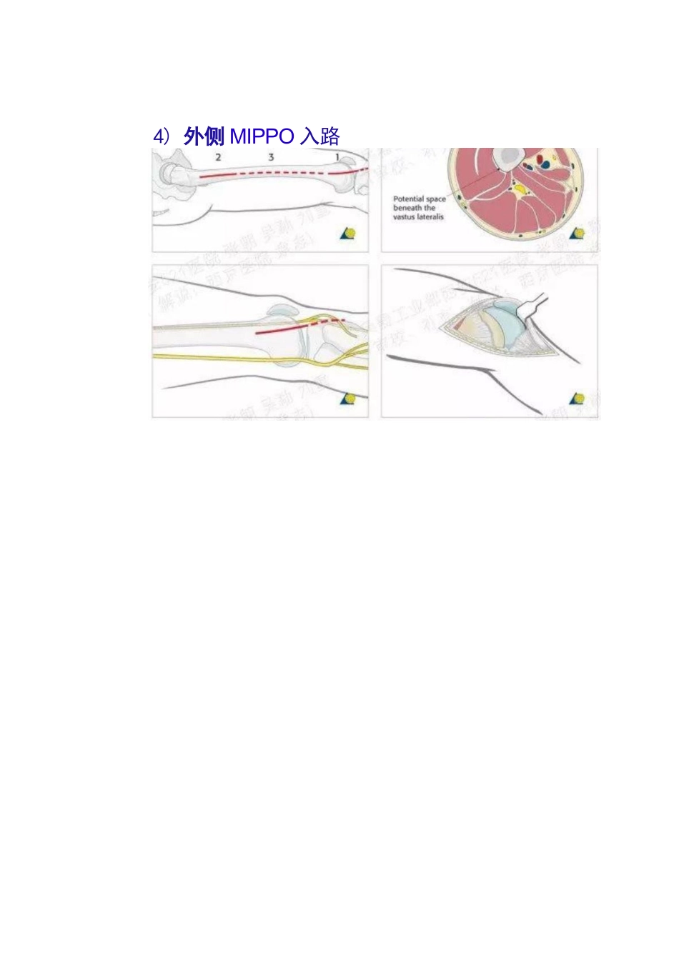 股骨远端骨折的手术治疗技巧_第13页