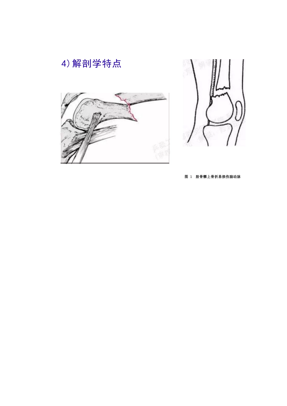 股骨远端骨折的手术治疗技巧_第8页