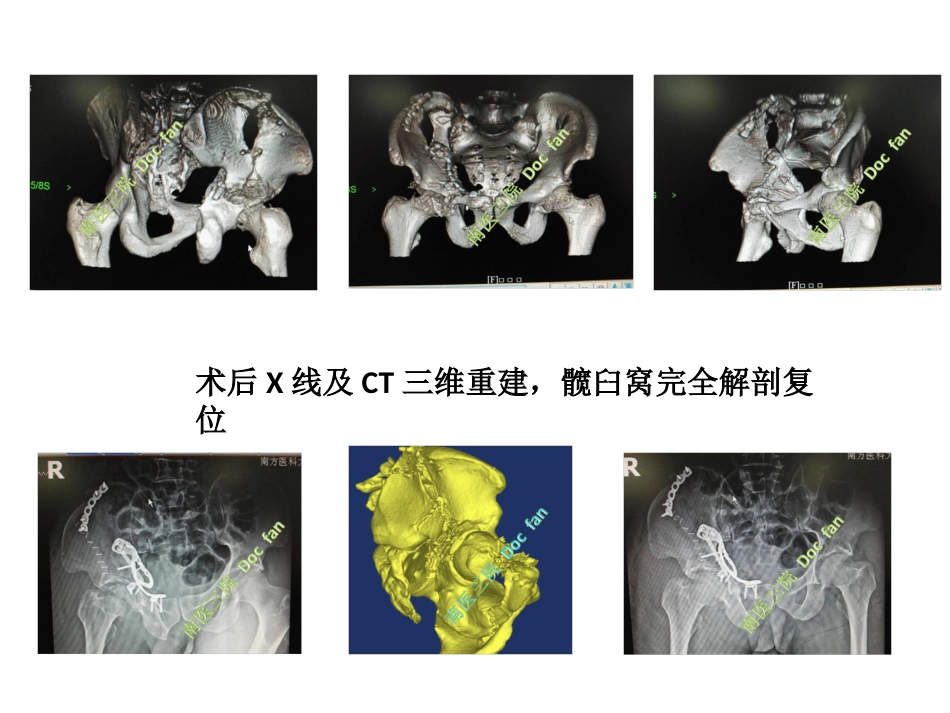 髋臼螺旋桨钢板治疗组合图_第4页