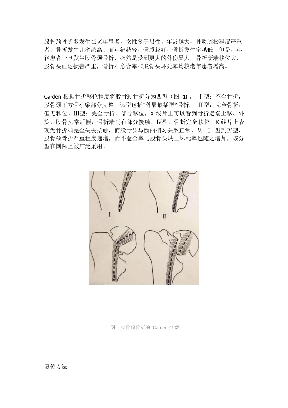 股骨颈骨折的复位方法_第1页