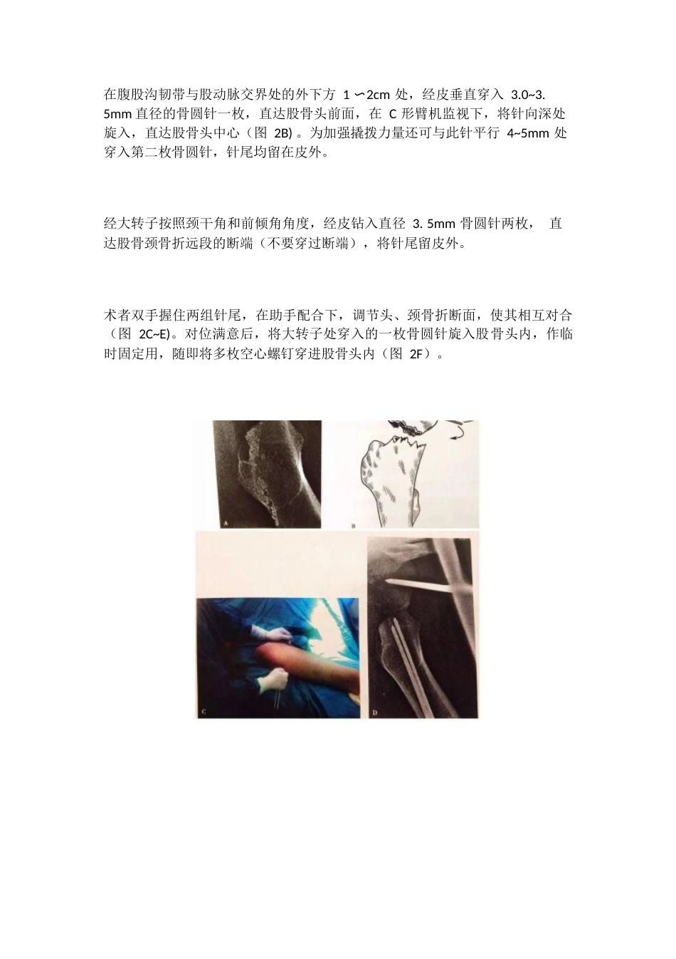 股骨颈骨折的复位方法_第3页