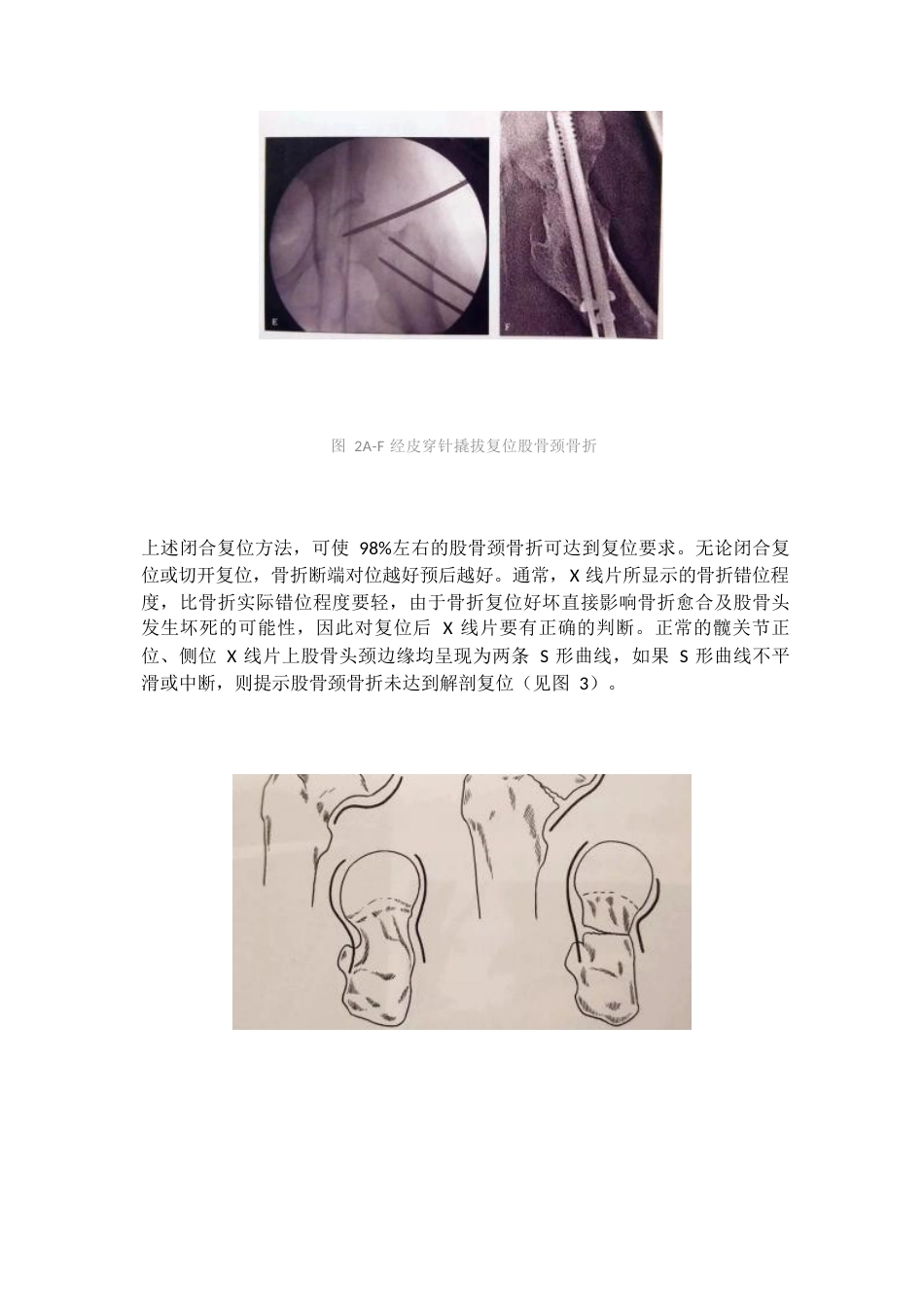 股骨颈骨折的复位方法_第4页