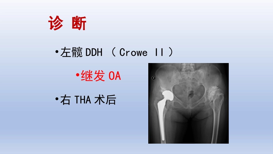DDH全髋关节置换手术难点及对策_第11页