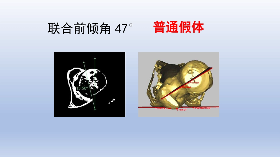 DDH全髋关节置换手术难点及对策_第13页