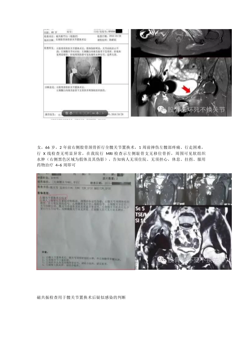 股骨头坏死应该怎样做检查_第8页
