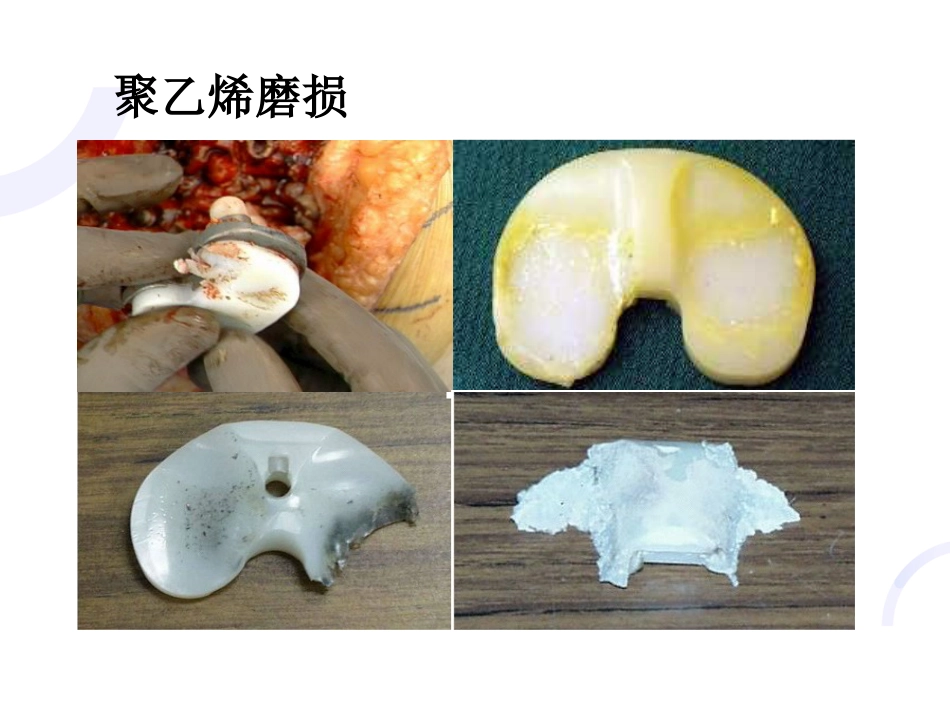 UKA与TKA 如何选择？_第15页