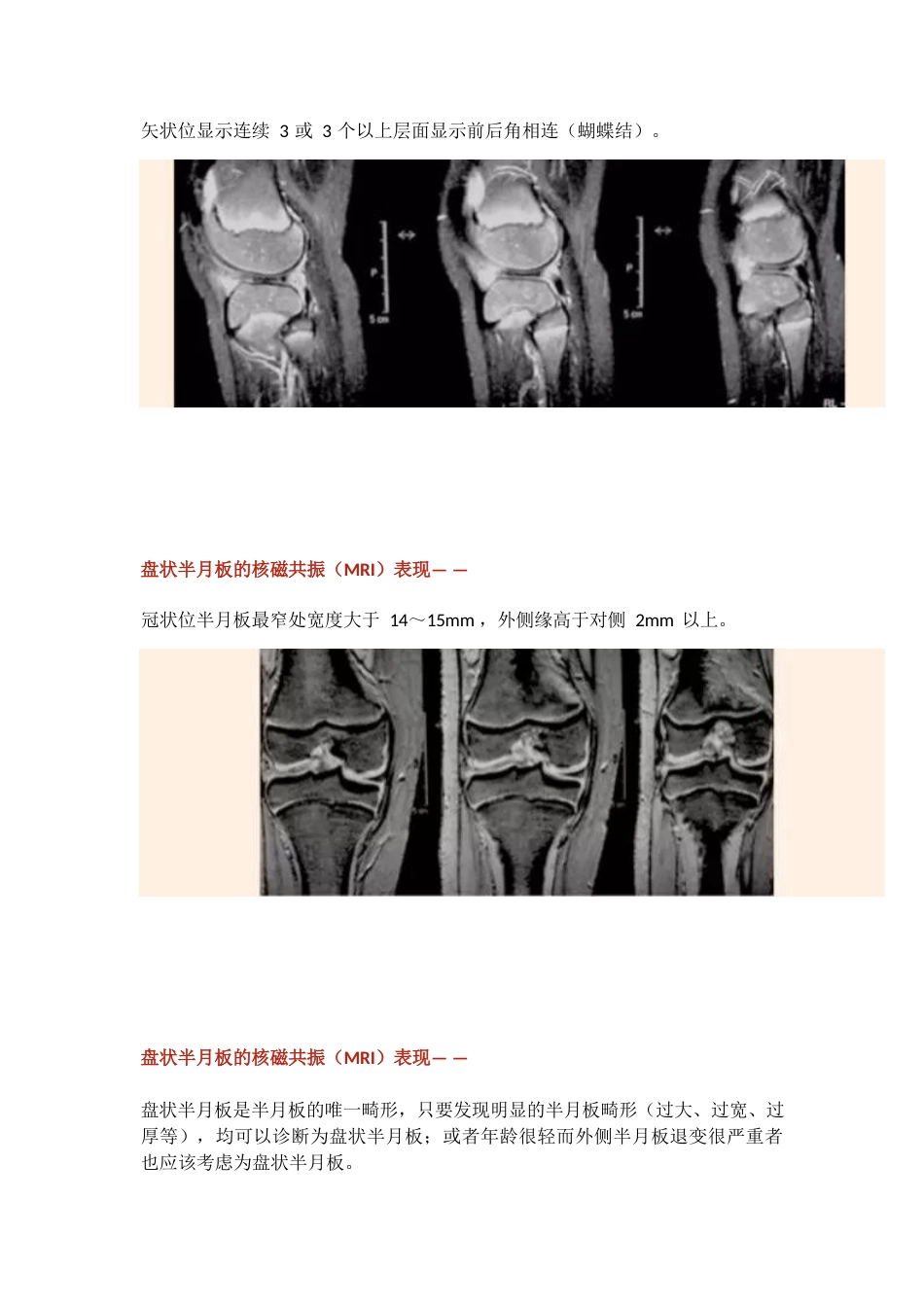 盘状半月板_第7页