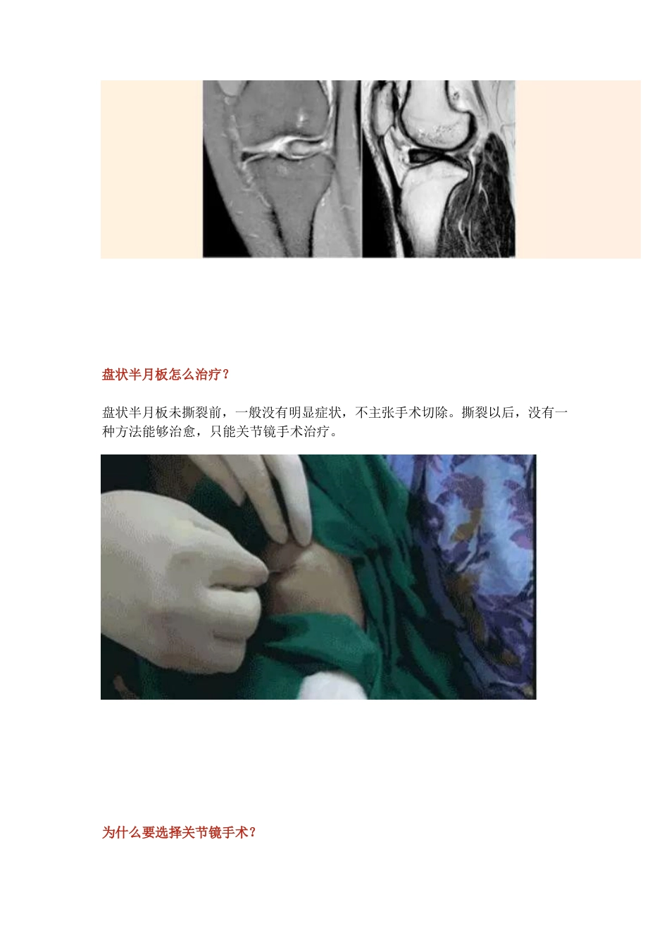 盘状半月板_第8页