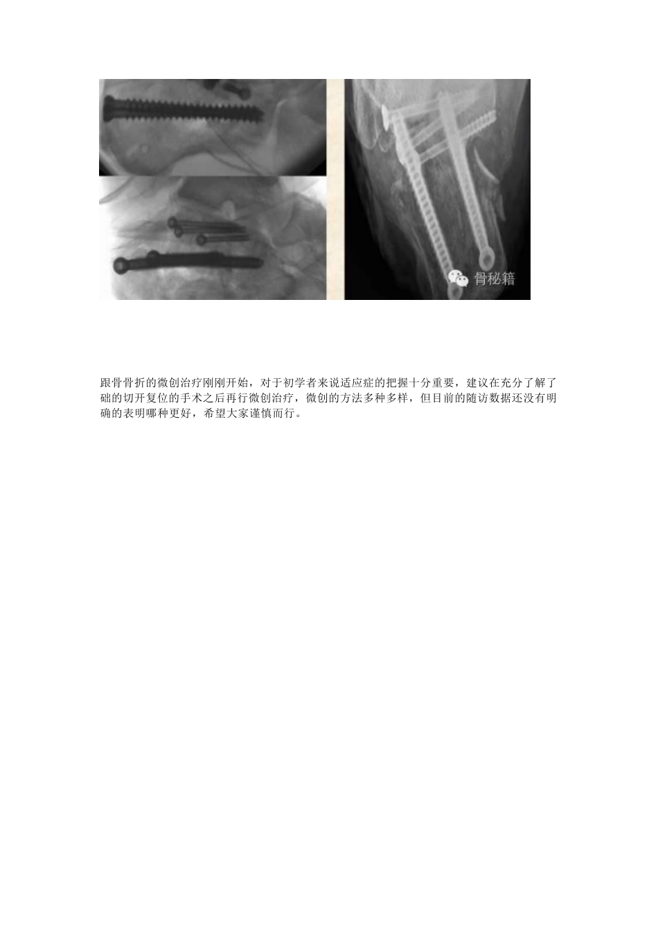 跟骨骨折你还在切开吗_第13页