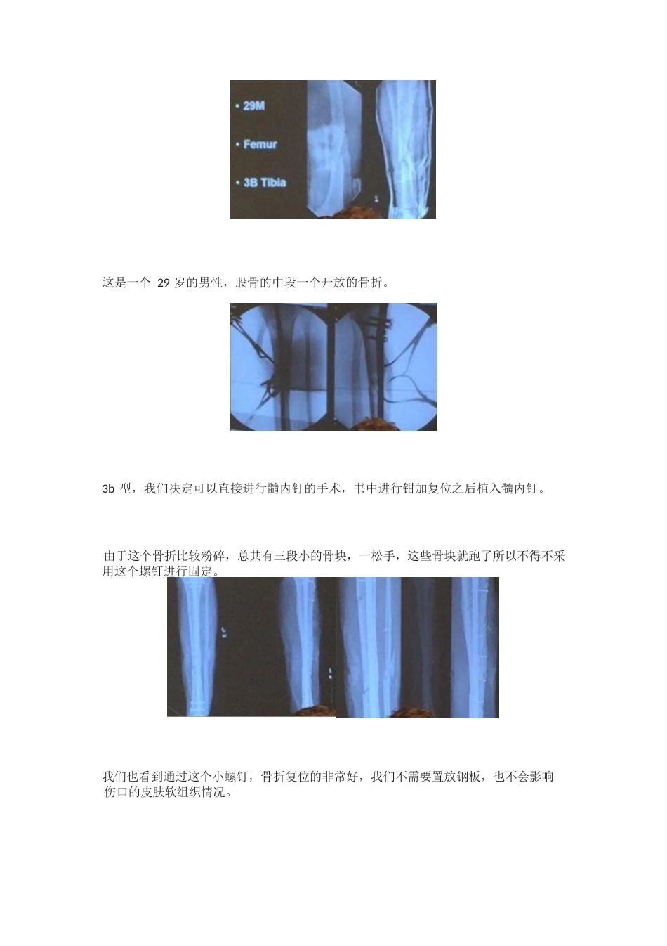 全皮质骨螺钉与迷你钢板的复位技巧_第3页