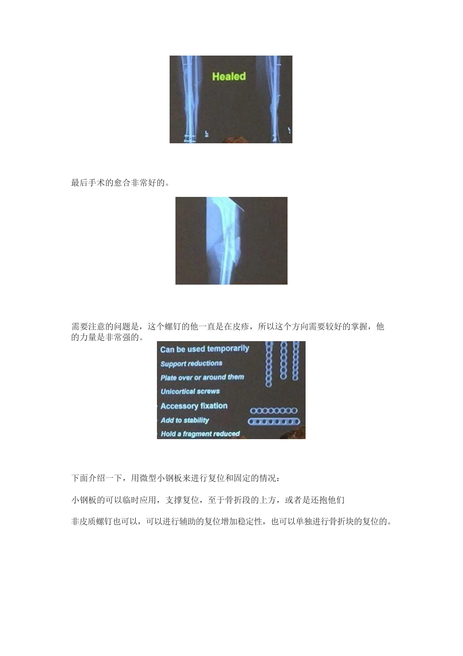 全皮质骨螺钉与迷你钢板的复位技巧_第4页