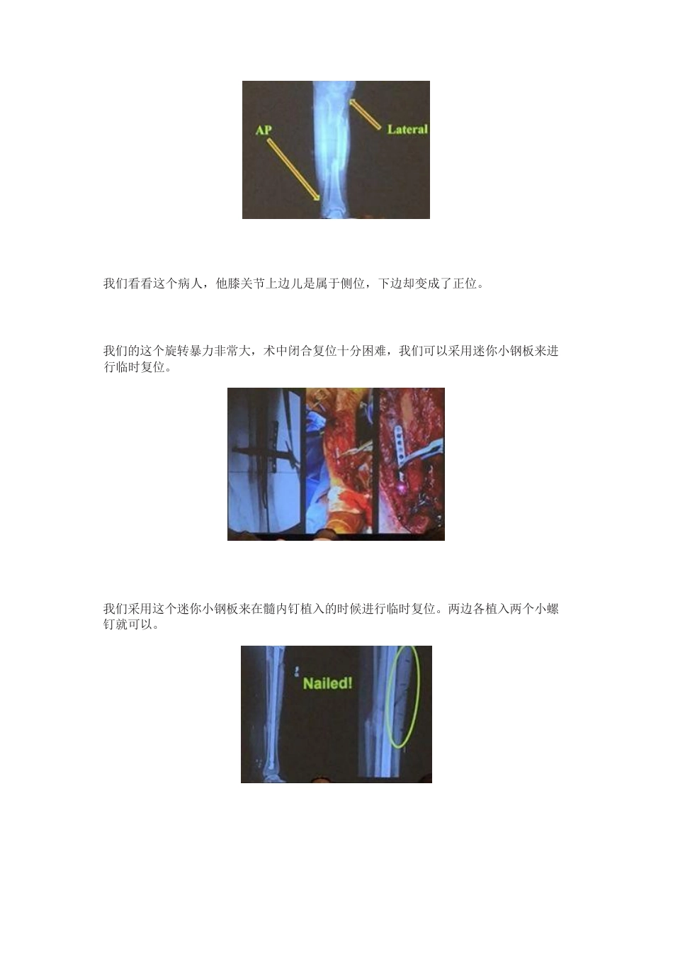 全皮质骨螺钉与迷你钢板的复位技巧_第5页