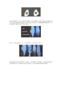全皮质骨螺钉与迷你钢板的复位技巧