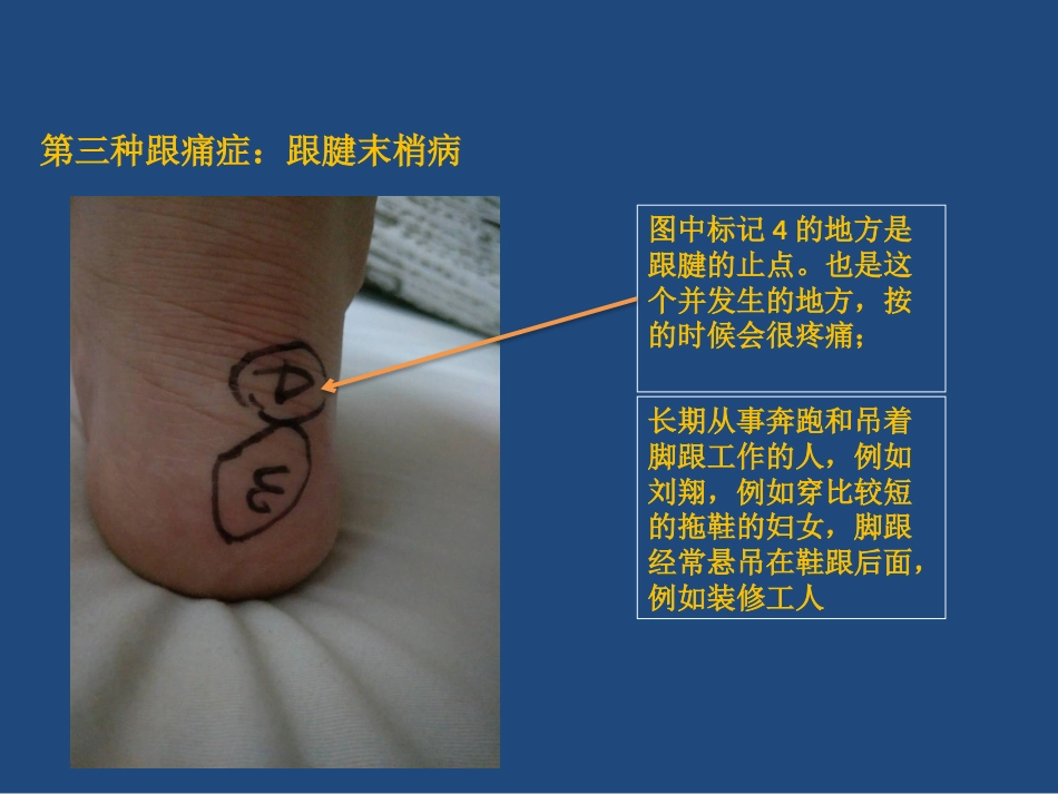 跟痛症课件_第11页