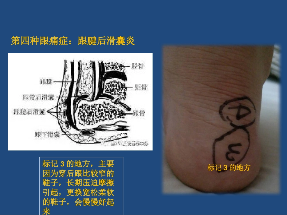 跟痛症课件_第15页