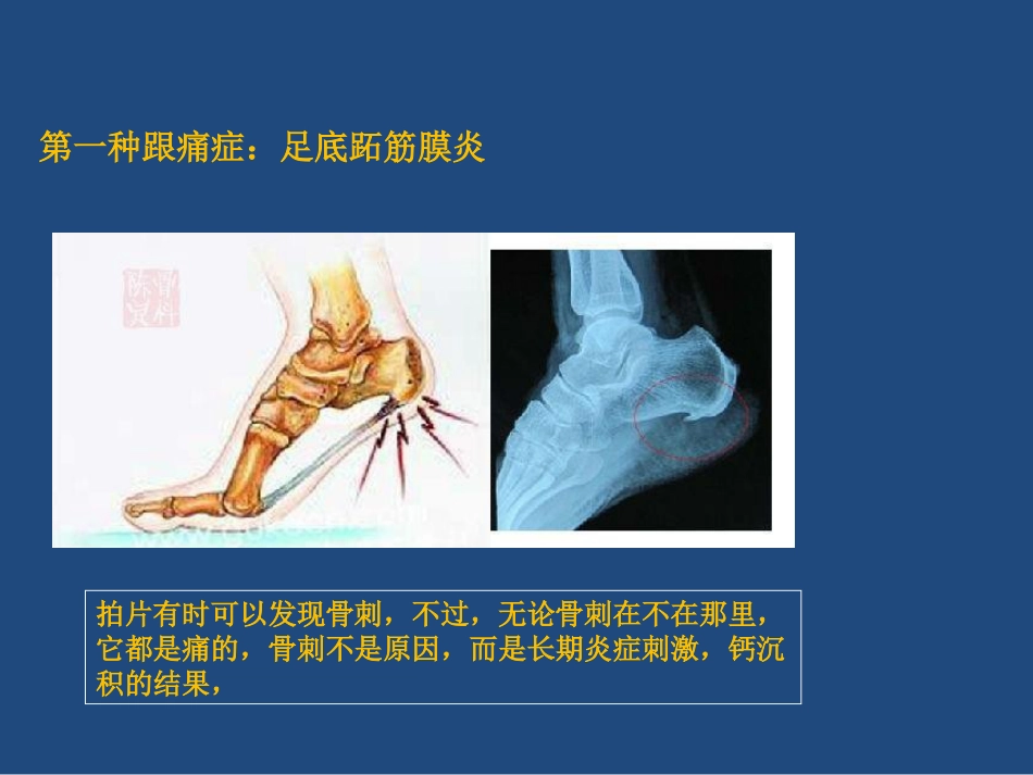 跟痛症课件_第5页