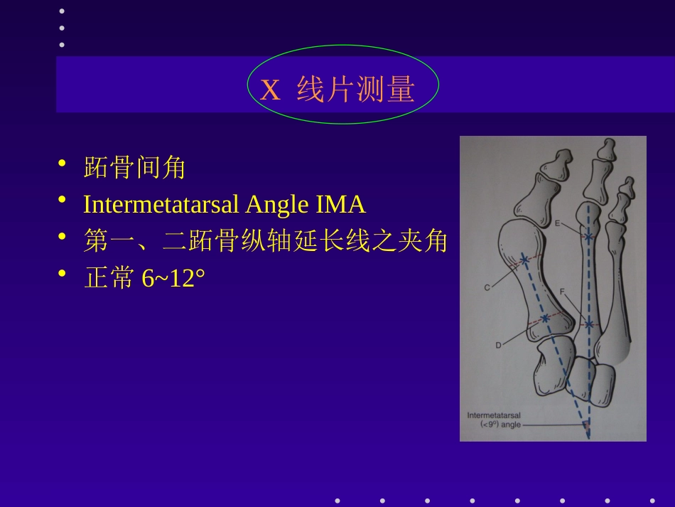 拇外翻分型及治疗_第10页