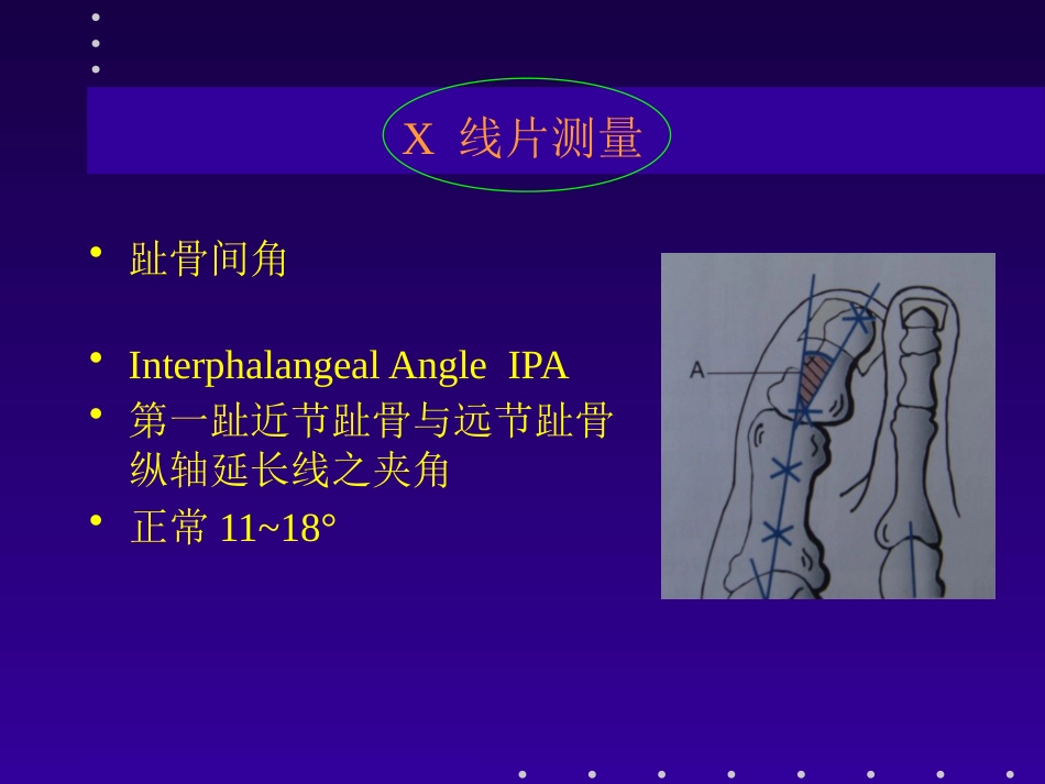 拇外翻分型及治疗_第11页