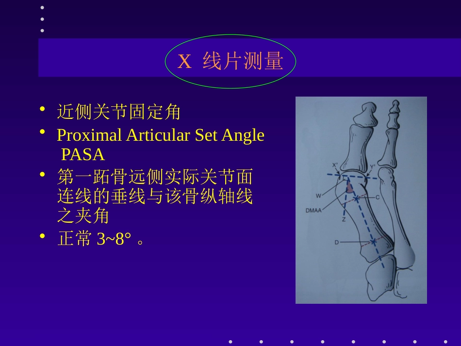 拇外翻分型及治疗_第12页
