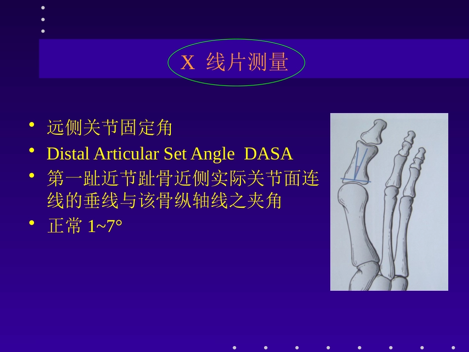 拇外翻分型及治疗_第13页