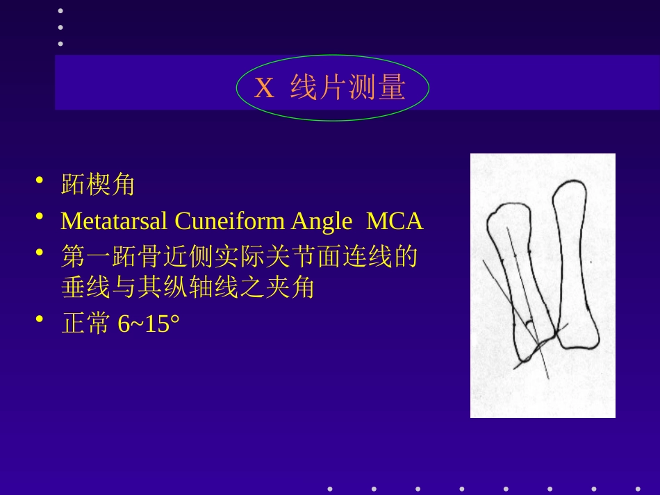 拇外翻分型及治疗_第14页