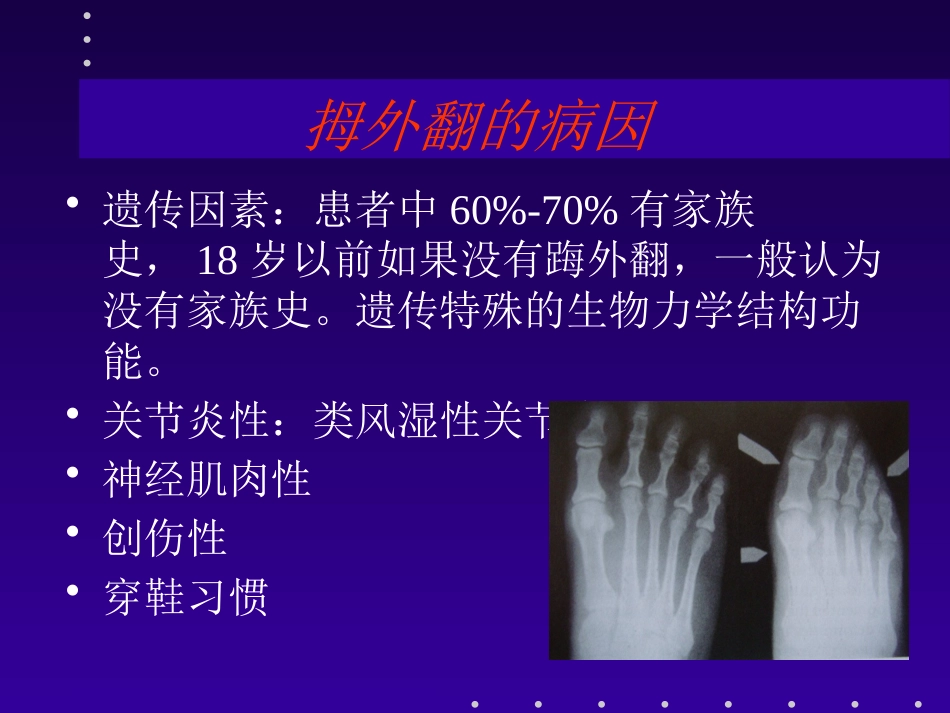 拇外翻分型及治疗_第4页