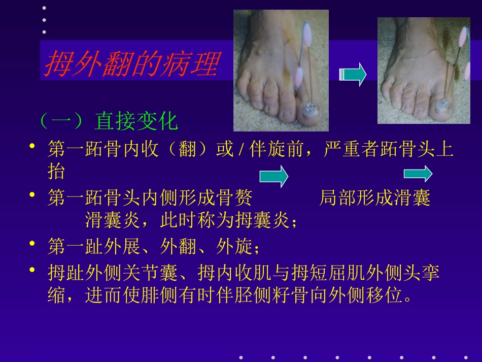 拇外翻分型及治疗_第5页