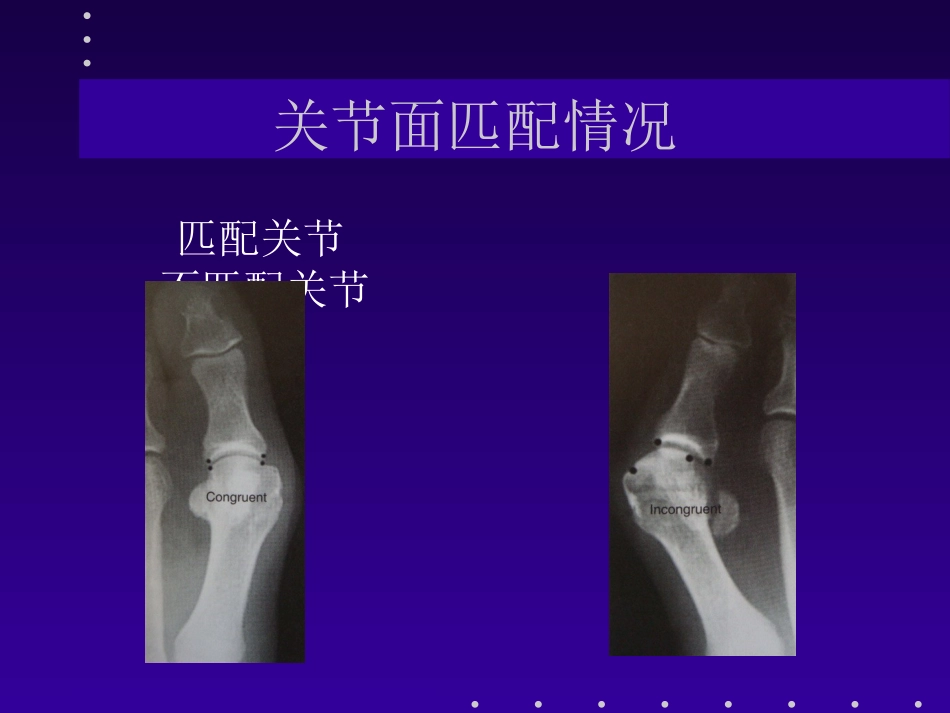 拇外翻分型及治疗_第8页