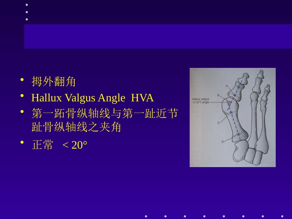 拇外翻分型及治疗_第9页