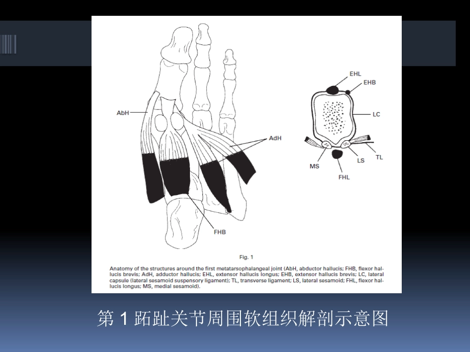 足拇外翻的治疗_第10页