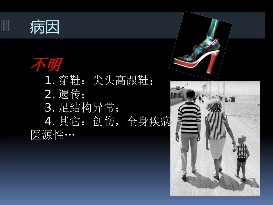 足拇外翻的治疗_第8页