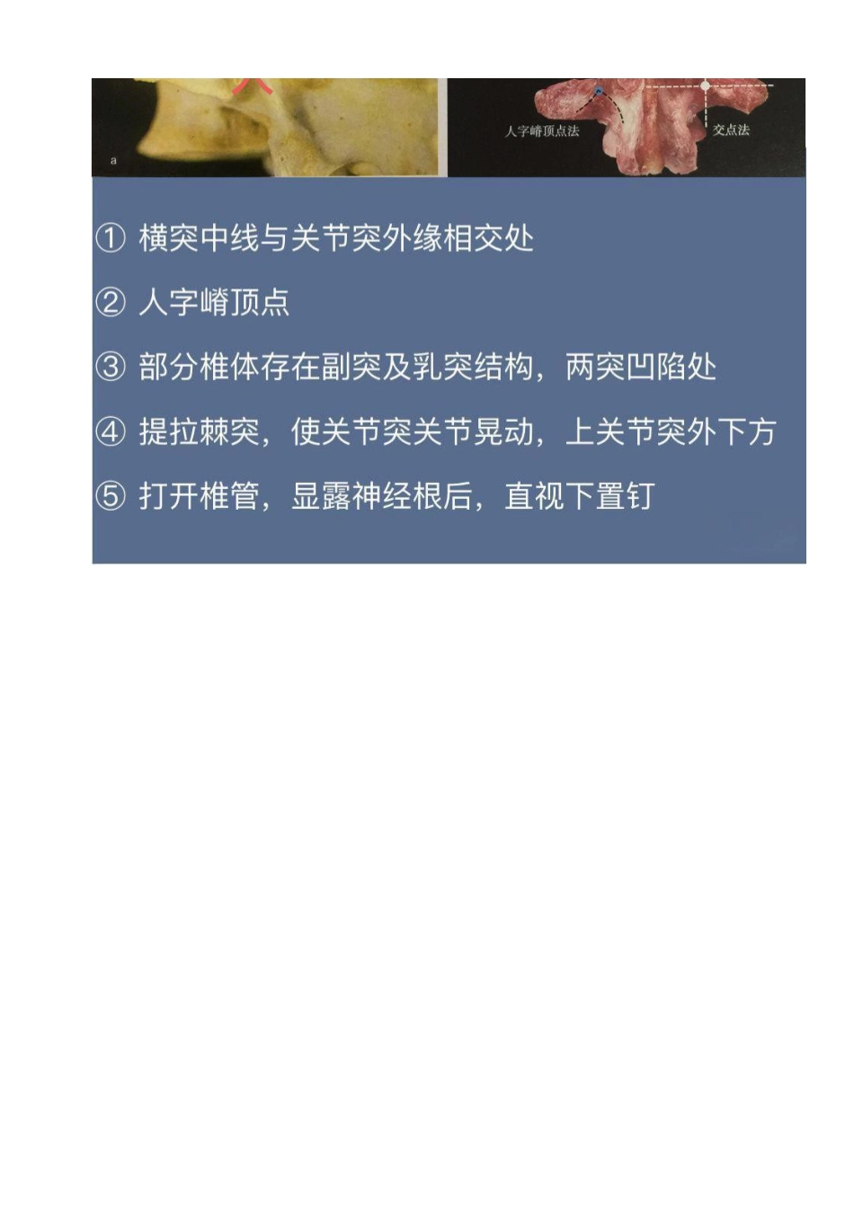 胸椎、颈椎、腰椎椎弓根置钉技术_第13页