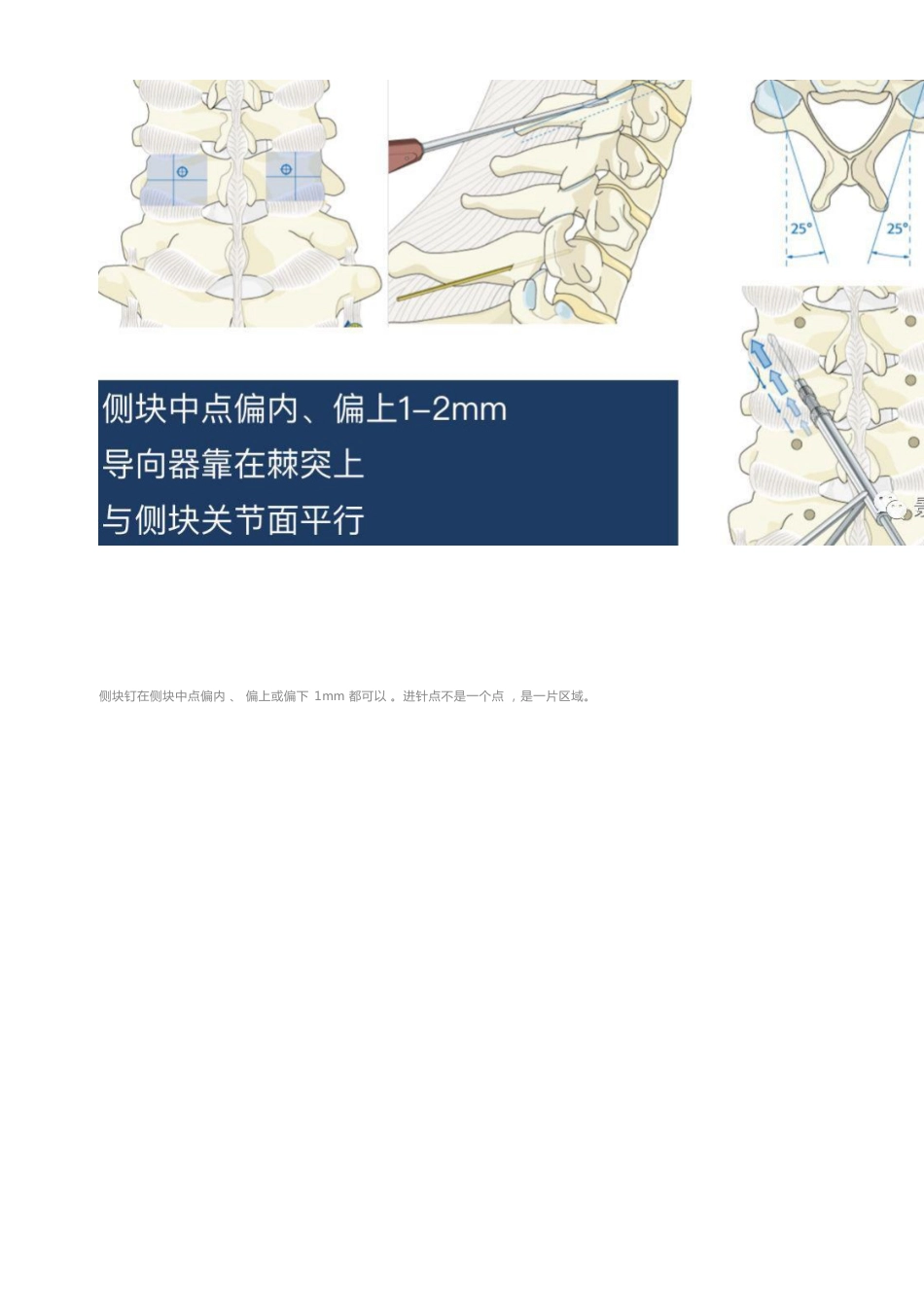 胸椎、颈椎、腰椎椎弓根置钉技术_第9页