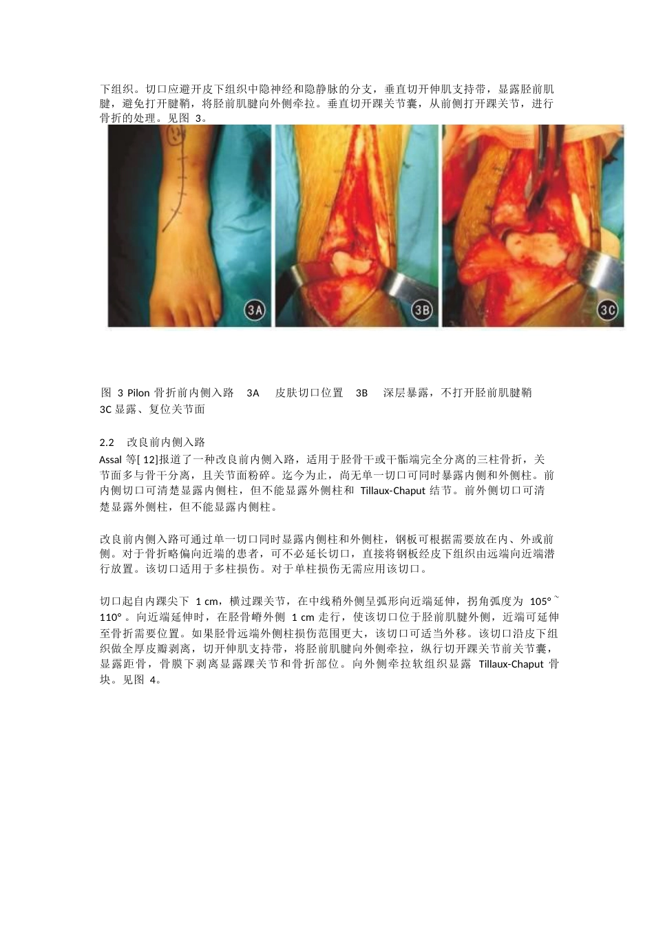 Pilon骨折的手术入路解析_第3页