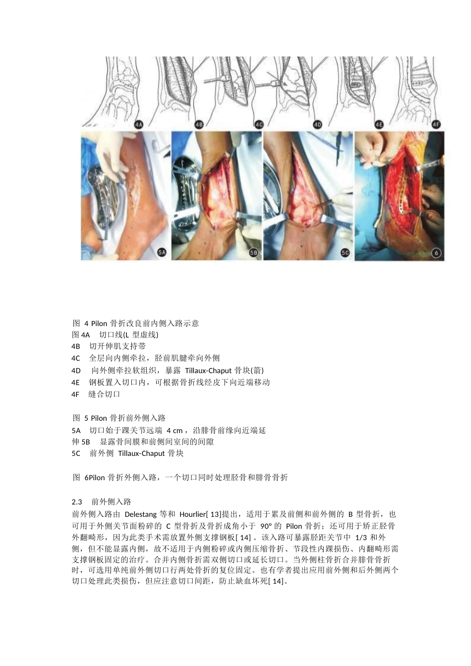 Pilon骨折的手术入路解析_第4页