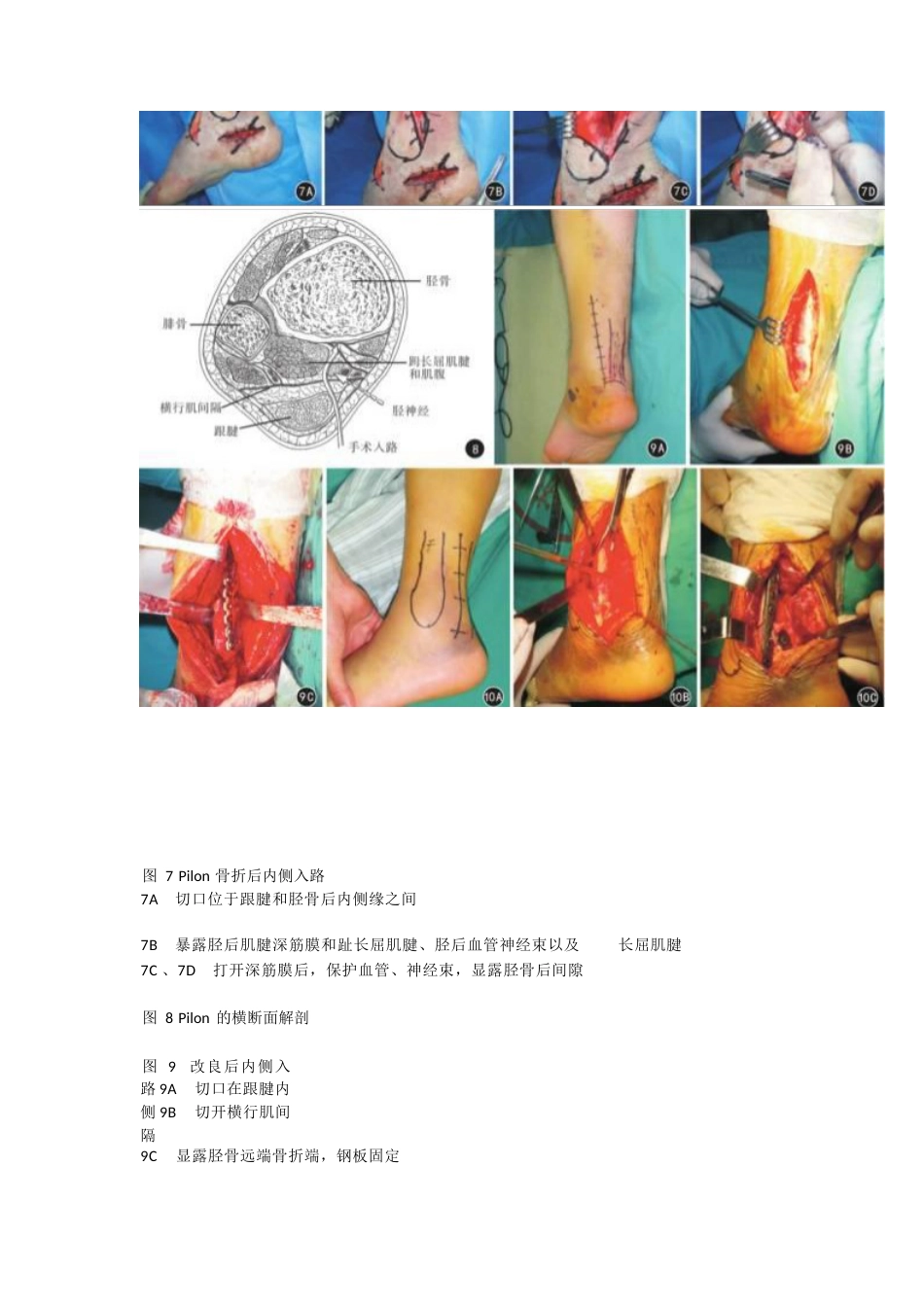 Pilon骨折的手术入路解析_第6页