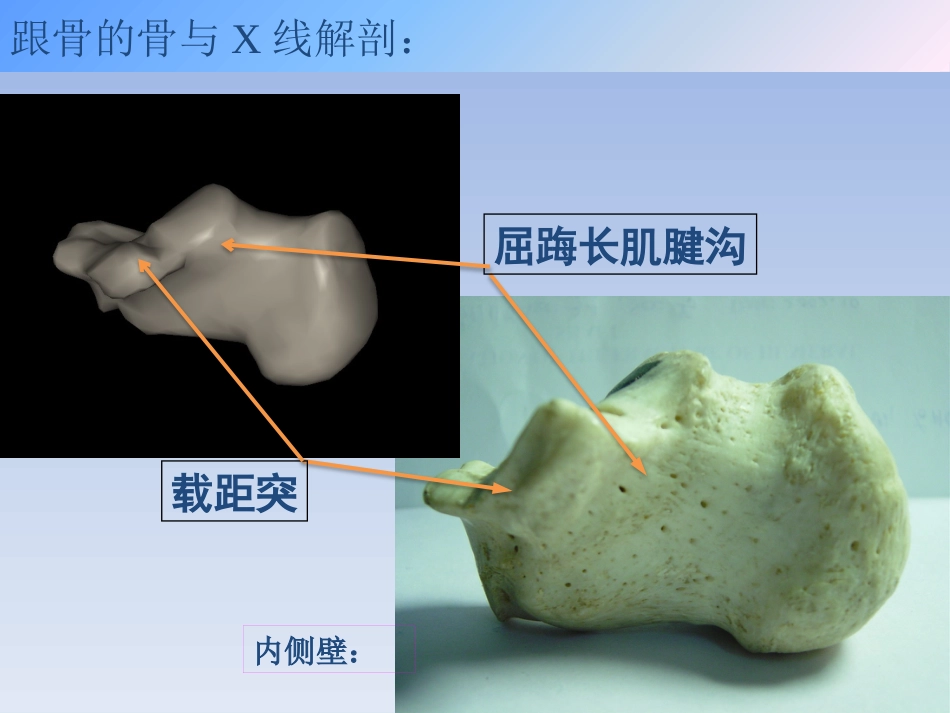 跟骨骨折的治疗_第5页