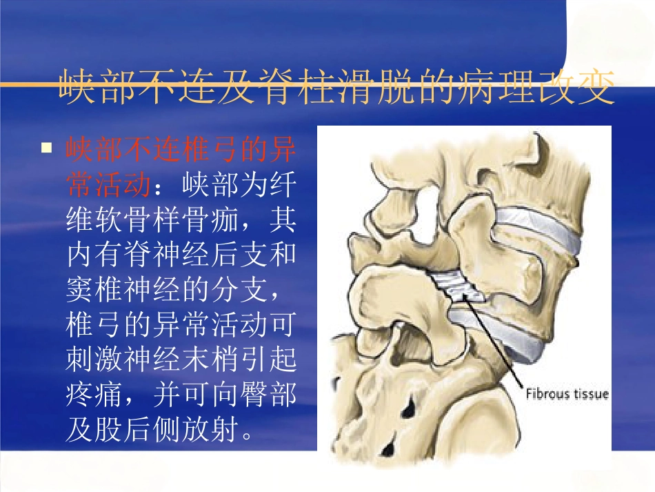 腰椎滑脱症_第12页
