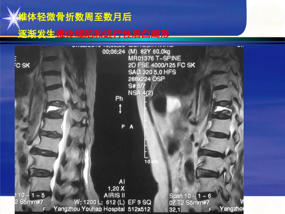 胸腰椎骨折_第15页
