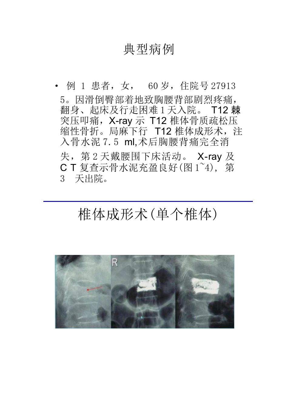 椎体成形术的操作技巧及要点_第4页