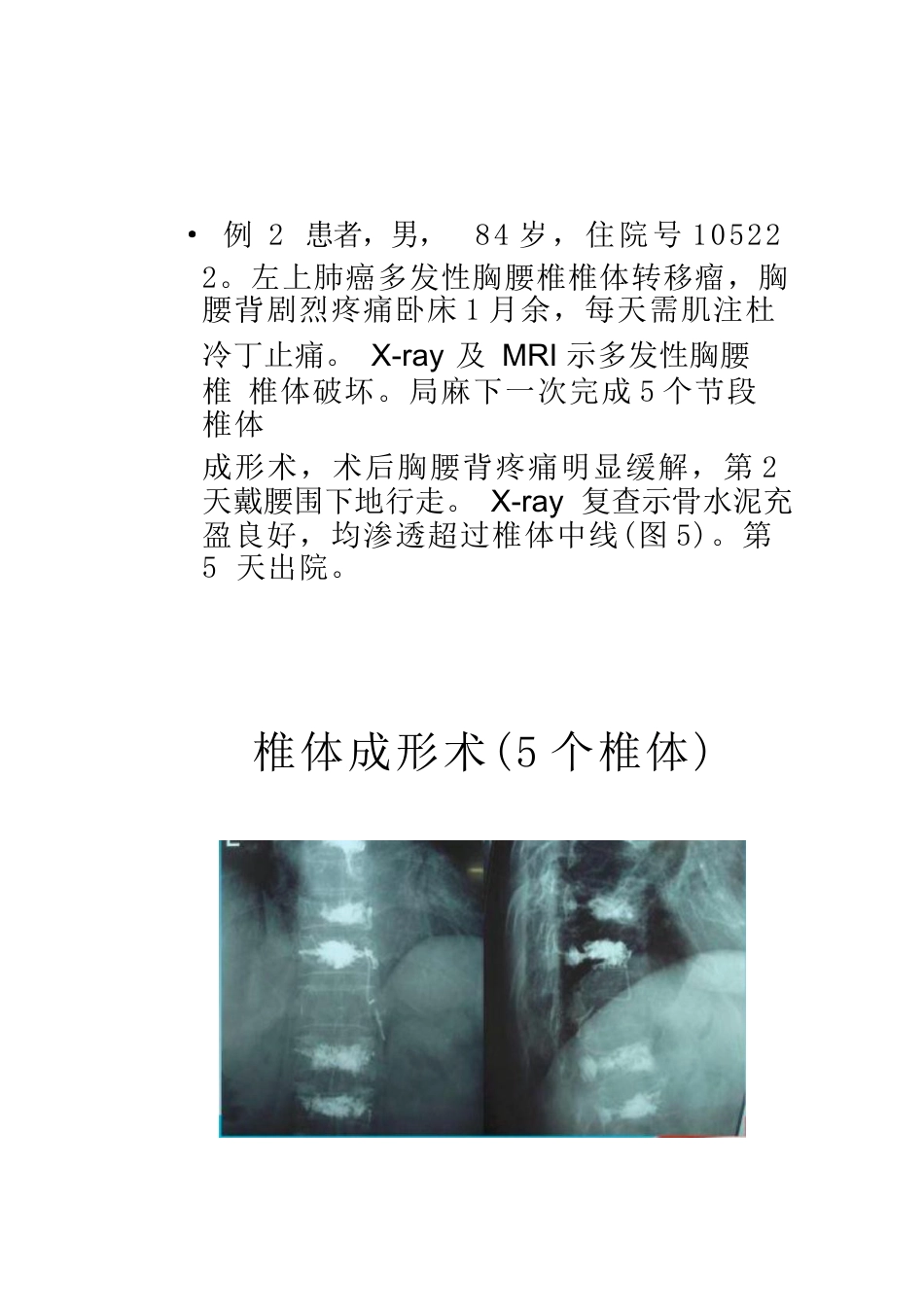 椎体成形术的操作技巧及要点_第5页