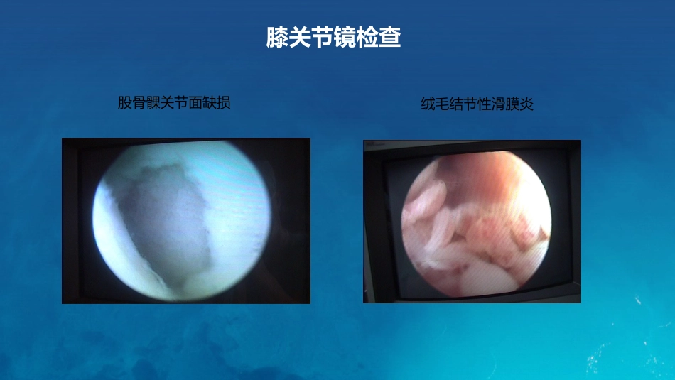 膝关节炎护理查房_第12页